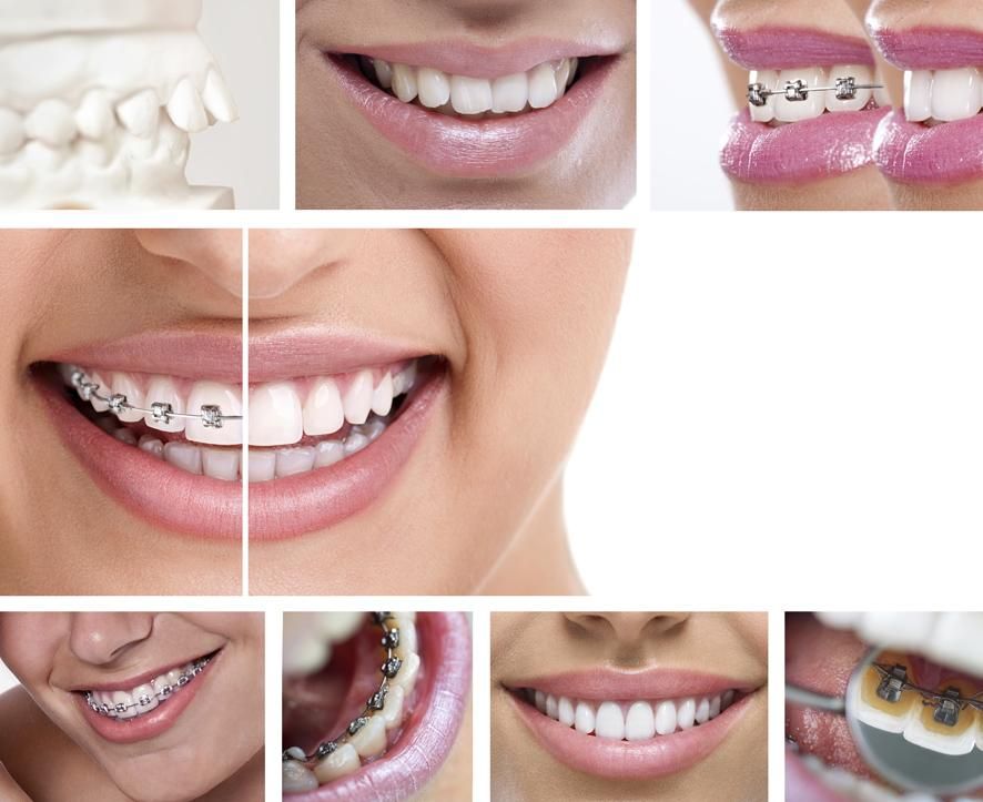 Clínica dental Coristanco sonrisas con brackets